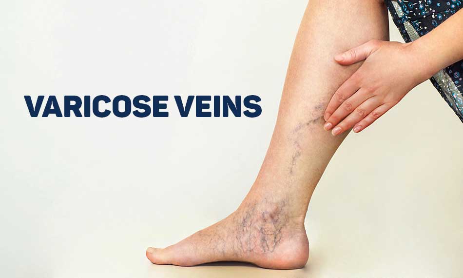 what is Varicose Veins how to cure