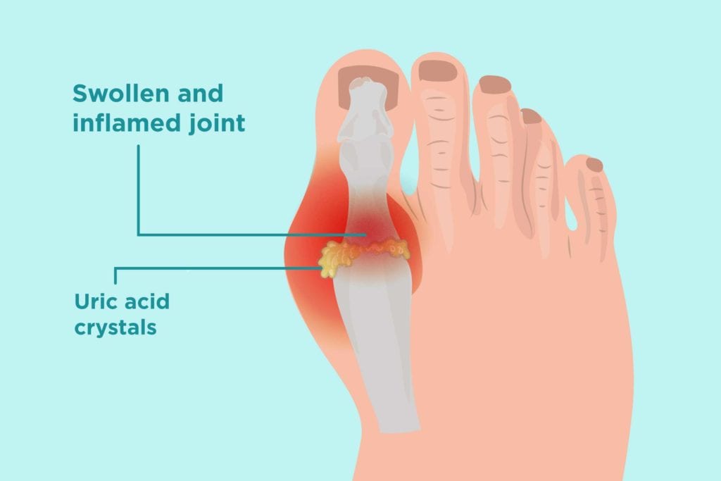 undrstand uric acid