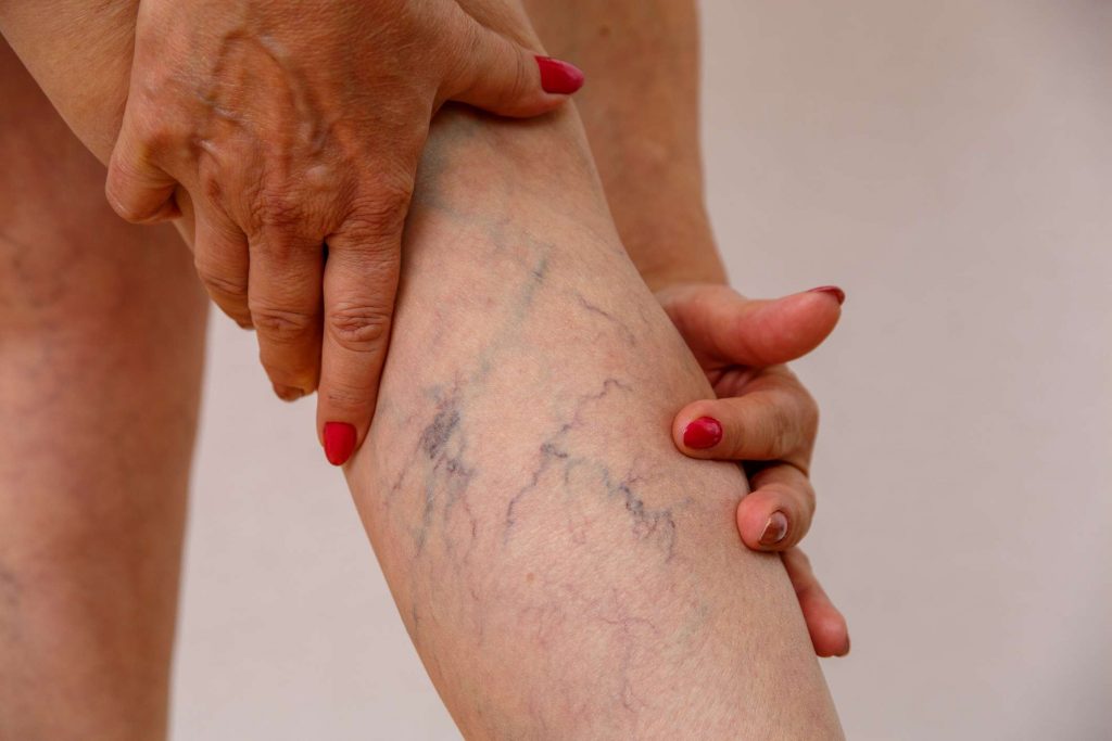 woman-showing-varicose-veins